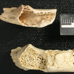 صورة تقارن بين عظم نياندرتال مصاب بالسرطان (الى الاعلى) وآخر سليم